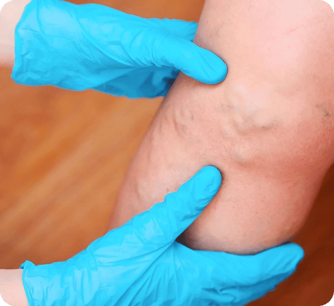 How is Vein RFA Performed?